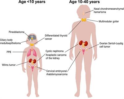 DICER1 Syndrome and Cancer Predisposition: From a Rare Pediatric Tumor to Lifetime Risk